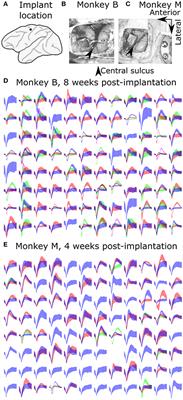 An Improved Unscented Kalman Filter Based Decoder for Cortical Brain-Machine Interfaces